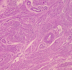 Uterus biopsy: Chronic cervicitis, leiomyoma, endometriotic cyst, show chronic inflammatory cells in sub-epithelial layer. Myoma.