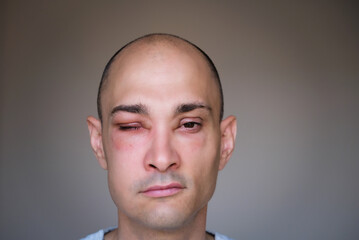 Caucasian man has angioedema around the eyes caused by allergic reaction to agents such as insect...