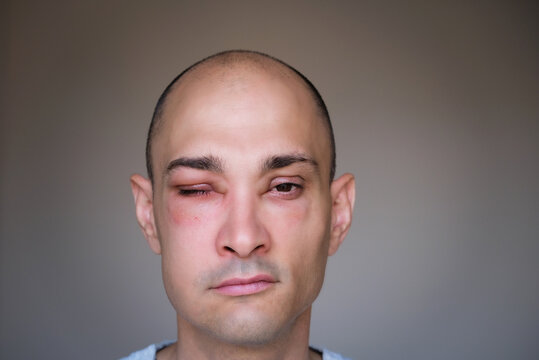Caucasian man has angioedema around the eyes caused by allergic reaction to agents such as insect bites, foods, or medications. Swollen face.