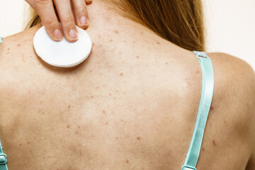 Woman acne on back cleaning skin with tonic
