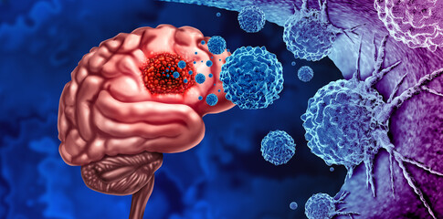 Glioma Cancer Tumor as malignant cells outbreak as a brain disease attacking neurons as a medical concept of neurological disease