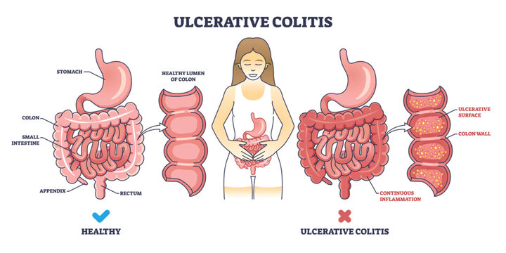 Ulcerative colitis as chronic inflammatory bowel disease outline diagram. Labeled educational scheme with medical illness of digestive system vector illustration. Ulcers inflammation description.