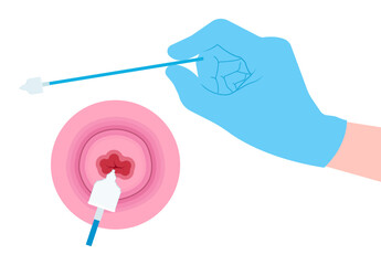 examine in women Obstetric swab with vulvar warts prevent by Pap smear test procedure the cervix cancer female and HPV cervical diagnostic of loop excision sex or LEEP cell cone cytology care screen - obrazy, fototapety, plakaty