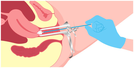 Examine in women female with obstetric swab vulvar warts prevent by Pap smear test procedure the cervix cancer and HPV cervical diagnostic of loop excision sex or LEEP cell cone cytology care screen © Pepermpron