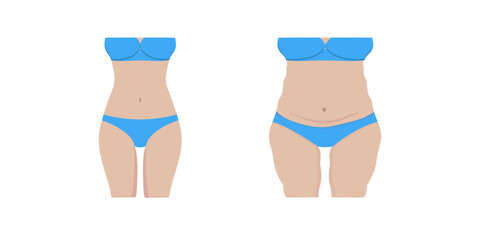 Vector illustration of a fat and thin female body. Isolated white background. Female body before and after weight loss. Flat style. Girl's stomach and breasts after weight loss