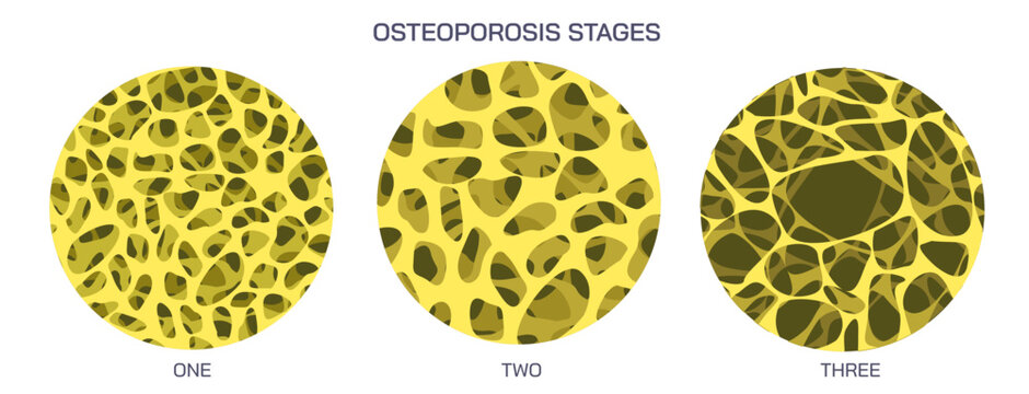 Bone density measurements and stages of osteoporosis. A bone disease that develops when bone mineral density and bone mass decreases, or the quality or structure  changes. vector illustration.