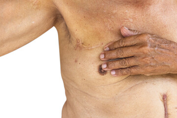 Naklejka premium Close up of Scar caused by abdominal aorta surgery in elderly men. Cyanotic keloid Scars caused by abdominal surgery and suturing. skin imperfections or defects.