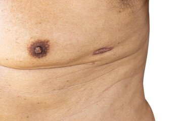 Close up of Scar caused by abdominal aorta surgery in elderly men. Cyanotic keloid Scars caused by...