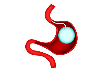 Gastric balloon weight loss intragastric surgery