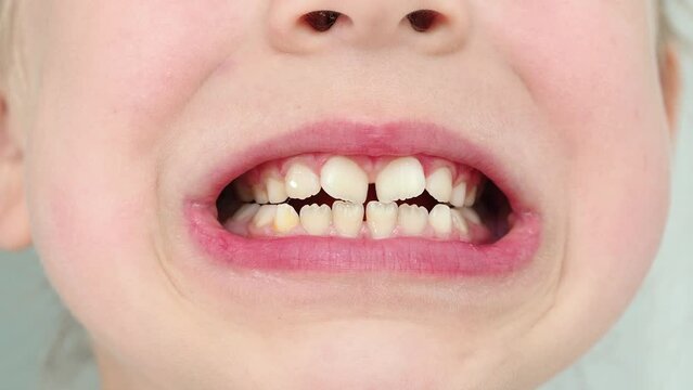 Children's molars crooked teeth large. Milk teeth. Malocclusion. Orthodontist and dentist. Smile for video tutorial
