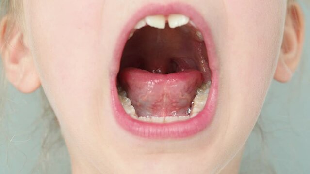 Wide open mouth with small uvula, palate and larynx. The child opened his mouth. Children's dentistry. Children's therapist, throat treatment. Overview of baby throat