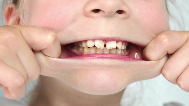 Widely stretched lips for a full roll view of the jaw. The problem of children's teeth. Crooked teeth. Gymnastics for speech, children's speech therapist. Video lesson on speech
