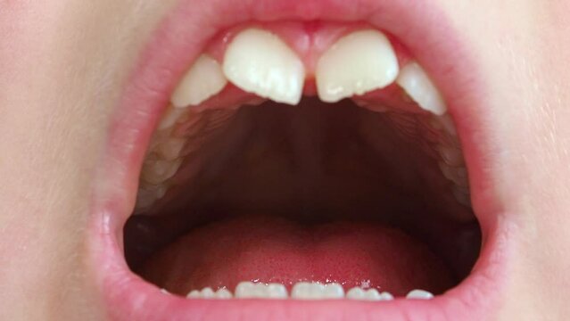 close up of mouth with braces. Children's open mouth large. Taste buds on the tongue. The child opened his mouth