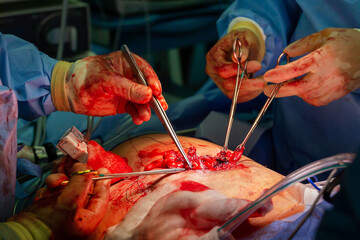 Surgical operation with spot light in the middle, closeup on operating field and hands of surgeons