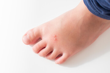 The Foot of a kid with an insect bite. Fire ant bites