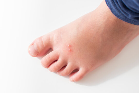 The Foot of a kid with an insect bite. Fire ant bites
