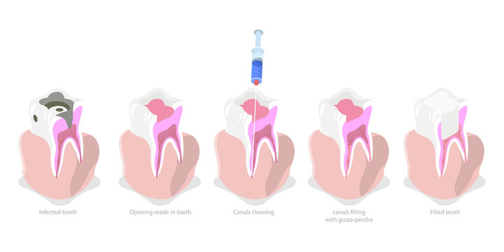 3D Isometric Flat  Conceptual Illustration of Tooth Decay