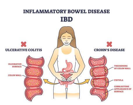 Inflammatory bowel disease or IBD with Crohns condition and ulcerative colitis outline diagram. Labeled educational scheme with chronic inflammation of gastrointestinal tract vector illustration.