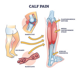 Calf pain explanation with cramp from muscle contraction outline diagram. Labeled educational scheme with leg anatomy and medical cause of sore rupture, strain or inflammation vector illustration. - obrazy, fototapety, plakaty