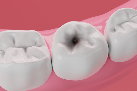 Teeth decay by bacteria 3D rendering.