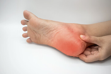 Inflammation at heel. Concept of foot pain. - obrazy, fototapety, plakaty