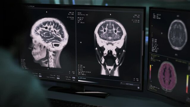X-ray scanner equipment interface imaging the patients brain. Medical system interface scanning the damaged brain. Diagnosis software interface scanning the brain of an emergency patient.