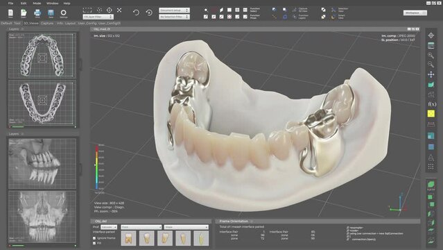 Modern computer program creates a digital projection of artificial teeth. Program visualises the artificial teeth insertion into the jaw. Program showing the artificial teeth replacements.