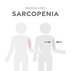 Sarcopenia, muscle loss medical scheme. Vector illustration with human body pictogram comparing normal Healthy muscle mass and weak old muscle atrophied in the aging process.  Medical infographic