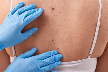 Dermatologist in rubber gloves examining patient's birthmark, closeup view