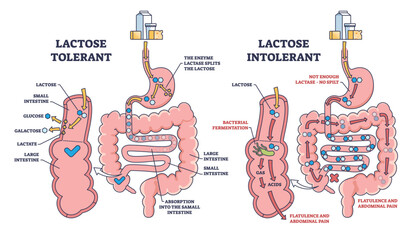 Lactose intolerance and tolerance medical process differences outline diagram. Labeled educational anatomical digestive tract splitting explanation with dairy milk allergy problem vector illustration