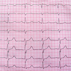 Electrocardiogram example of a normal 12-lead sinus rhythm, close up