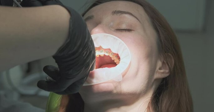 Dentist orthodontist, removes braces using dental nippers. Bites wire on teeth of the patient woman.