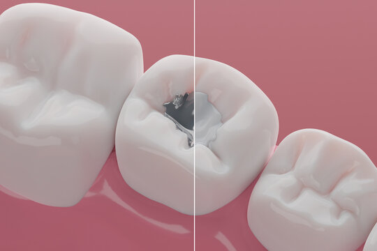 Teeth Mercury or Silver Amalgam Fillings Compare to Composites, Declay treatment and Dental clinic illustration concept. 3D rendering