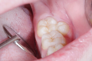 Supernumerary tooth in the mandible of the mouth. An underdone premolar. Close-up photo in dentist...