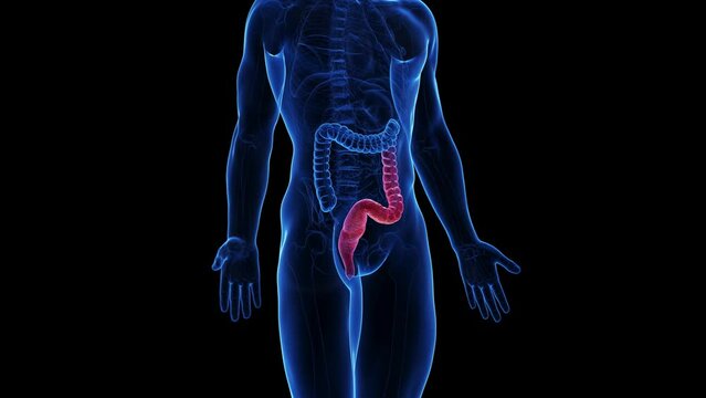 Animation of the colon of a man with colitis ulcerosa