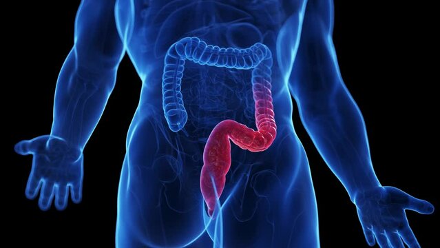 Animation of the colon of a man with colitis ulcerosa
