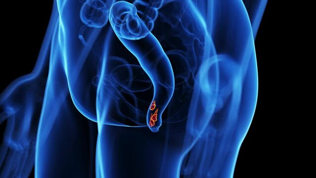 Animation of hemorrhoids