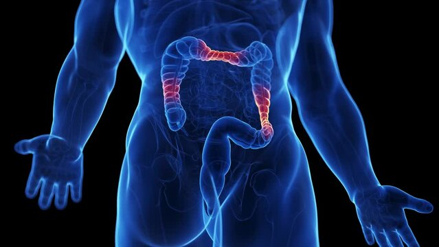 Animation of irritable bowel syndrome