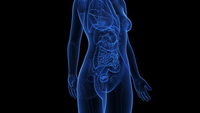 Animation of rectal cancer