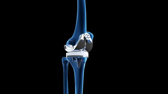 Animation of a knee replacement
