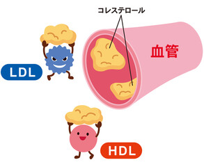 LDLとHDLの仕組み　脂質異常症　血管　コレステロール