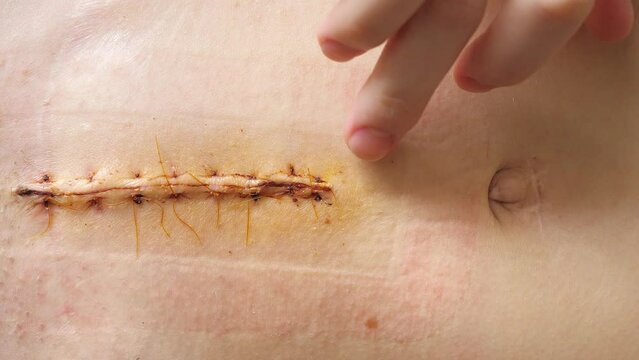 Abdomen of young girl. Closeup video of the long scar above navel after abdominal surgery for umbilical and inguinal hernias. Irritation from the patch. Postpartum recovery.