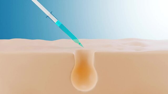 3D illustration of a syringe containing blue essence is being injected into the pore on skin. Imitation of the view through a microscope