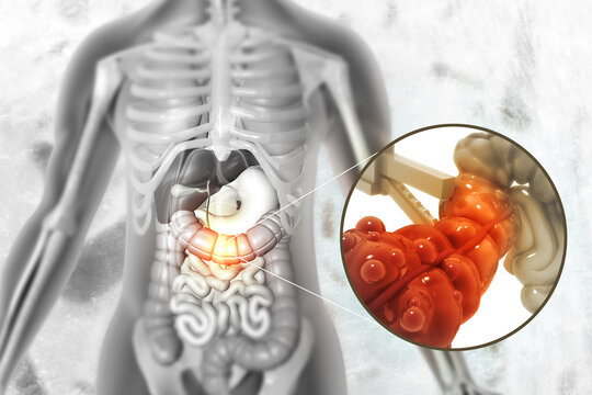 Laparoscopic appendix surgery. 3d illustration