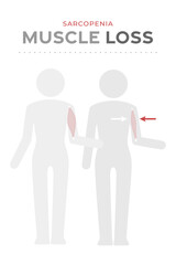 Sarcopenia, muscle loss icon. Human body pictogram with healthy muscle mass and  muscle loss, lose muscle. Muscular pathology medical infographic vector. In elderly. Large and small biceps on the arm