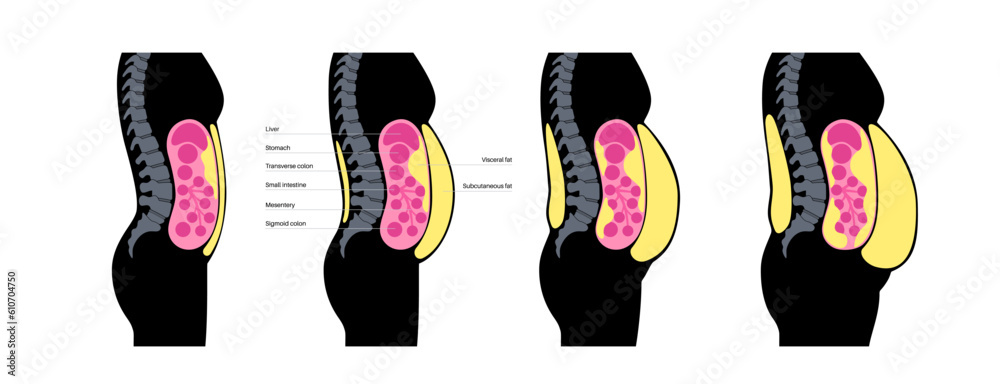 Wall mural Visceral fat diagram