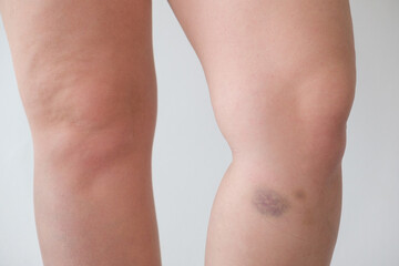 bruise on the girl's leg