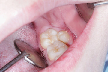 Supernumerary tooth in the mandible of the mouth. An underdone premolar. Close-up photo in dentist office. Dental examination of the patient with dental mirror.
