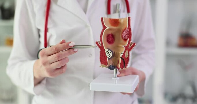 Treatment of diseases of the rectum, hemorrhoids and constipation. Proctologist points to the pathology of rectum on anatomical model
