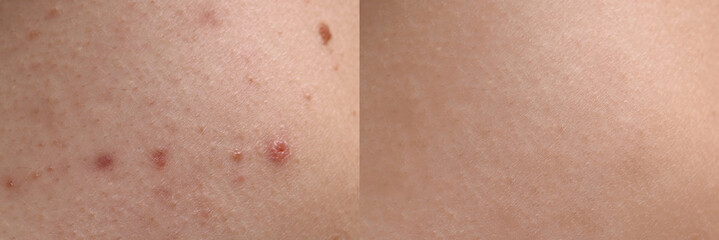 Collage with photos of person suffering from acne before and after treatment, closeup. Banner...
